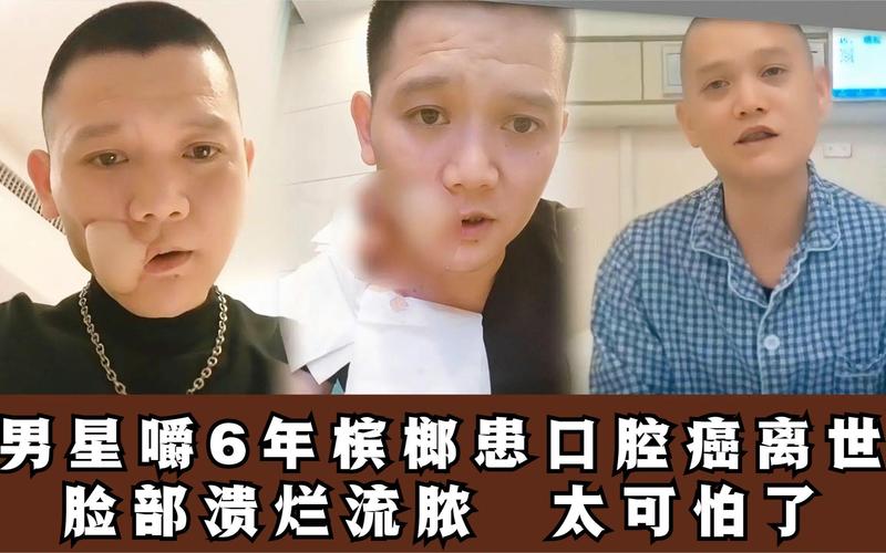 2025年新澳门天天开好彩:嚼槟榔20年患口腔癌